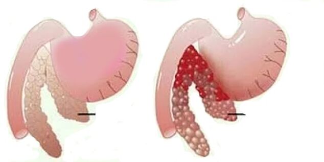 Pankreatitas